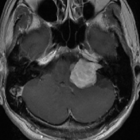 聴神経鞘腫の造影MRI 術前