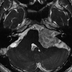 聴神経鞘腫の造影MRI 術前