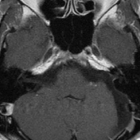 聴神経鞘腫の造影MRI 術後