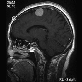 髄膜腫（傍矢状洞）の造影MRI