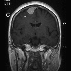 髄膜腫（傍矢状洞）の造影MRI