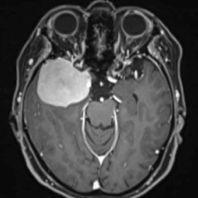 髄膜腫の造影MRI（蝶形骨縁部）