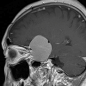 髄膜腫の造影MRI（蝶形骨縁部）