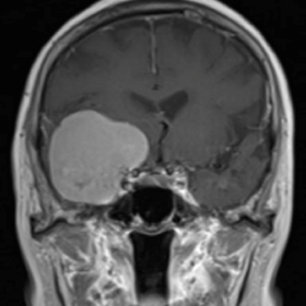 髄膜腫の造影MRI（蝶形骨縁部）