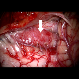 髄膜腫の術中写真（大孔部）