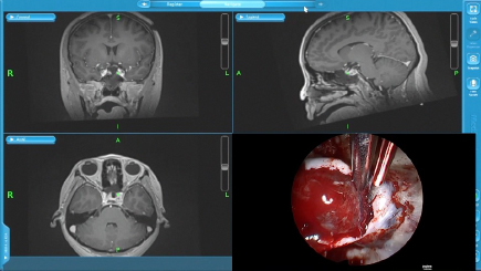 MRIを撮影し、ナビゲーションを更新し、残存腫瘍を確認