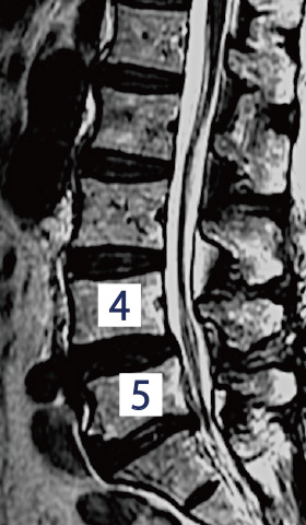 減圧術 術後MRI