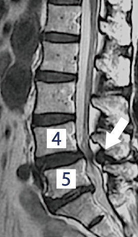 減圧術 術前MRI