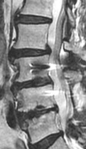 不安定性腰椎に対する固定術 術後