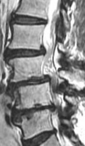 不安定性腰椎に対する固定術 術前