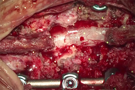 不安定性腰椎に対する固定術 術中