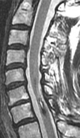 髄内腫瘍 術後MRI