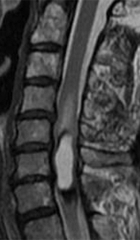 髄内腫瘍 術前MRI