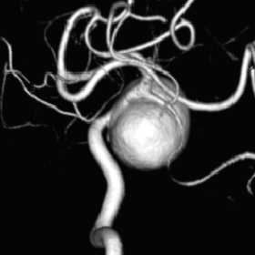 外科治療（脳動脈瘤クリッピング術） 術前