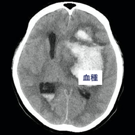 脳内出血CT写真 術前