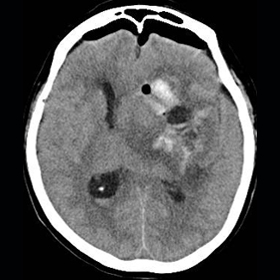 脳内出血CT写真 術後