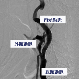 頚動脈ステント留置術 術後