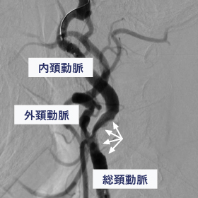頚動脈ステント留置術 術前
