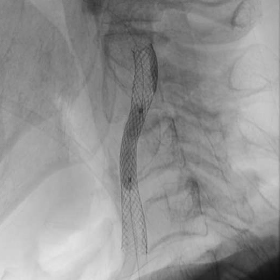 頚動脈ステント留置術 術中