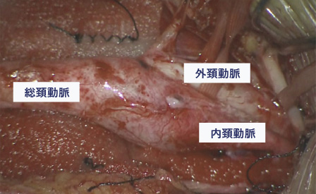 頚動脈内膜剥離術 術前