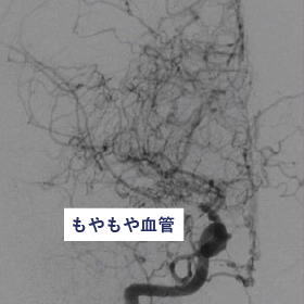 手術前後の血管撮影所見